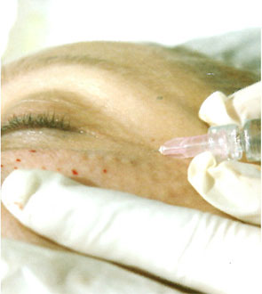 dermavit1 Dermarevitalizace obrázek 9