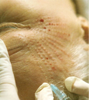 dermavit2 Dermarevitalizace obrázek 10