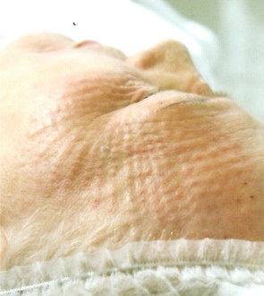 dermavit3 Dermarevitalizace obrázek 11