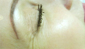 dermavit_result1 Dermarevitalizace obrázek 12