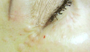 dermavit_result2 Dermarevitalizace obrázek 13