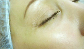 dermavit_result3 Dermarevitalizace obrázek 14