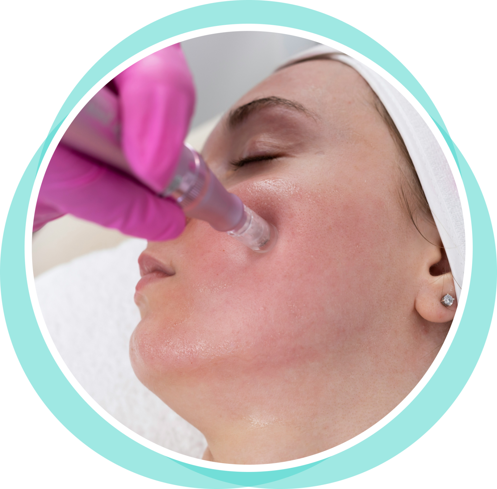 Frame 15 (8) Microneedling obrázek 7