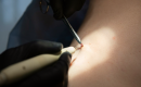 Laser vs. chirurgické odstranění bradavic. Která metoda je rychlejší, šetrnější a účinnější? obrázek 18 Laser vs. chirurgické odstranění bradavic. Která metoda je rychlejší, šetrnější a účinnější? obrázek 17