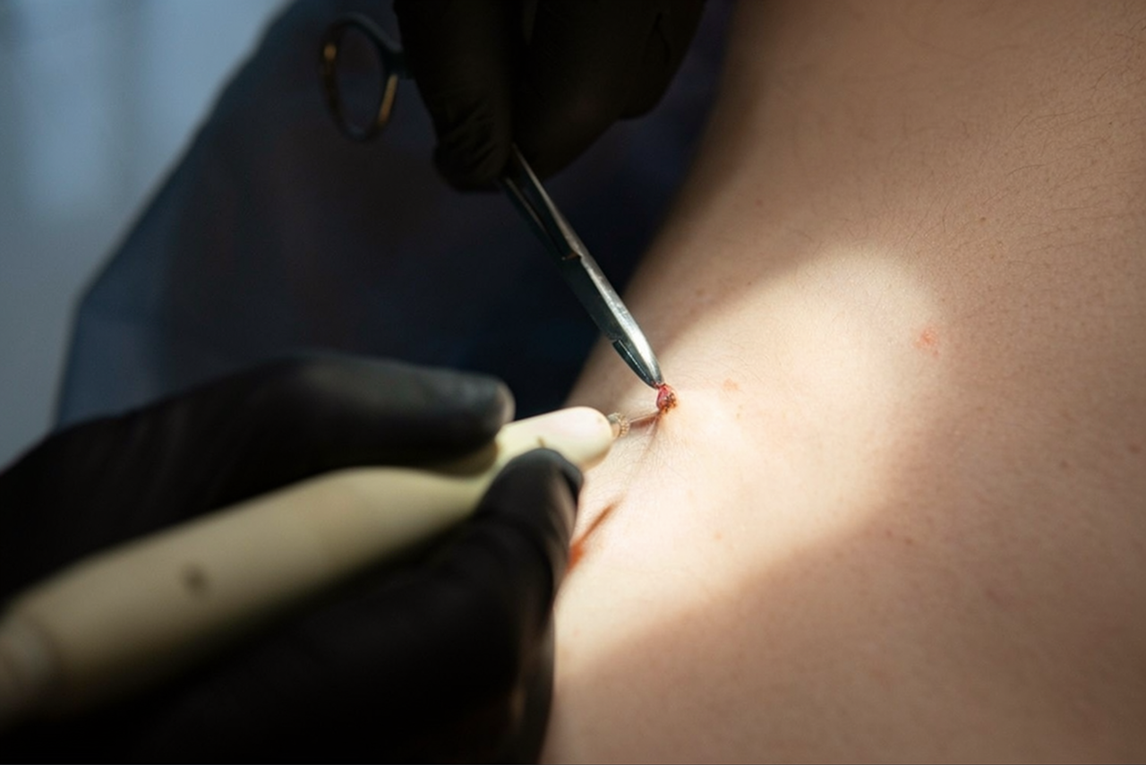Laser vs. chirurgické odstranění bradavic. Která metoda je rychlejší, šetrnější a účinnější? obrázek 22 Laser vs. chirurgické odstranění bradavic. Která metoda je rychlejší, šetrnější a účinnější? obrázek 21