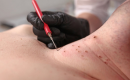 Jak odstranit malé bradavičky na krku? Průvodce domácími metodami i klinickými zákroky obrázek 14 Jak odstranit malé bradavičky na krku? Průvodce domácími metodami i klinickými zákroky obrázek 13