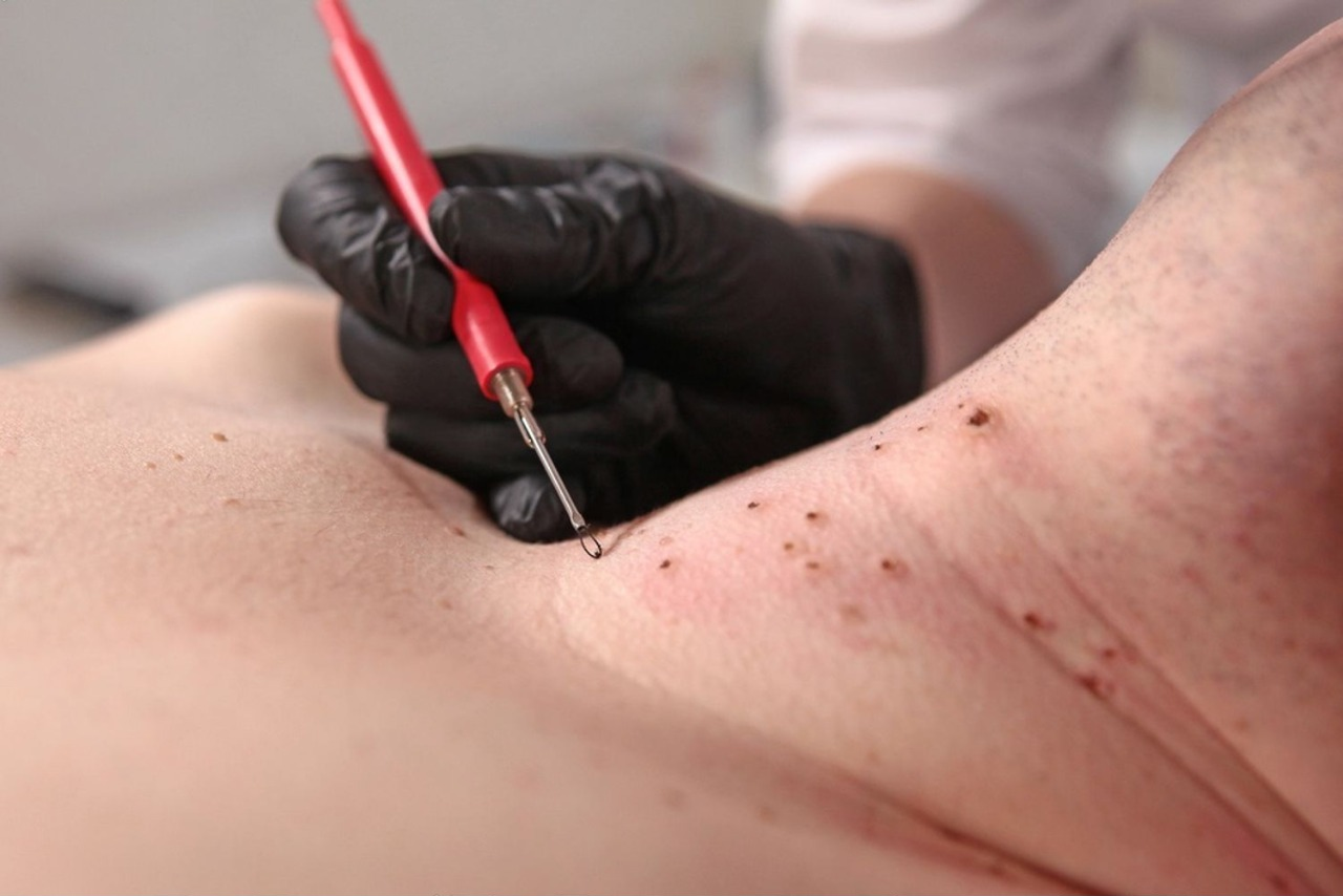 Jak odstranit malé bradavičky na krku? Průvodce domácími metodami i klinickými zákroky obrázek 2 Jak odstranit malé bradavičky na krku? Průvodce domácími metodami i klinickými zákroky obrázek 1